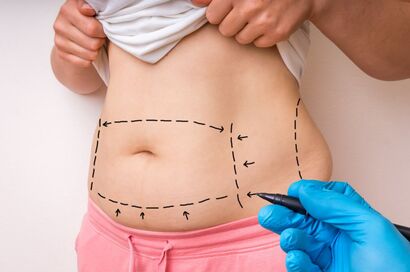 Fat Removal/Liposuction