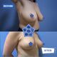 Breast reduction 