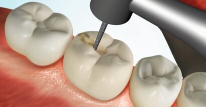 Lateral Composite Filling