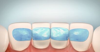 Fixing the swinging teeth with glass fiber application